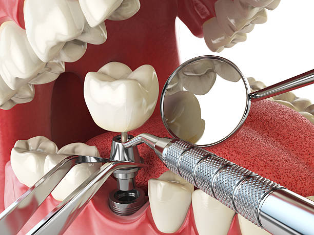 Best Emergency Tooth Extraction  in Mdleton, ID